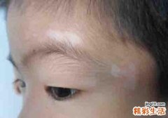 汗斑与白斑的区别 仔细看看这些