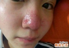 酒糟鼻形成的原因