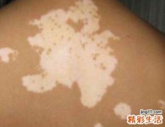 引起女性白癜风病因有哪些