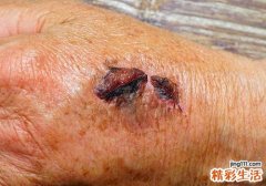 跌打损伤喝什么药酒 跌打损伤需要注意什么