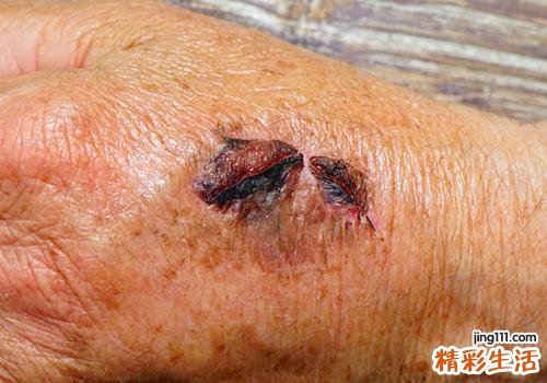 跌打损伤喝什么药酒 跌打损伤需要注意什么