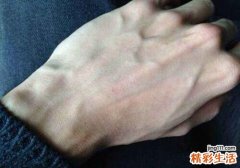 为什么有些人青筋暴露,青筋暴露是什么病