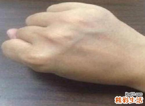 青筋明显是什么原因 青筋分布代表健康状态