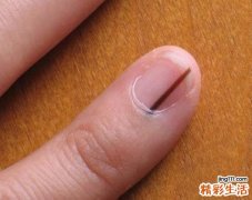 指甲上有黑线是怎么回事