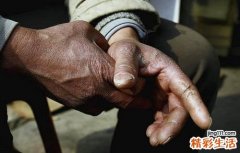 手足皲裂的原因 改善手足皲裂的方法