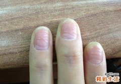 手冻了怎么办