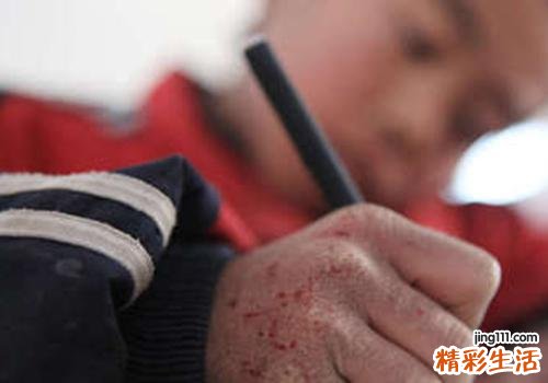 手冻肿了怎么快速消肿
