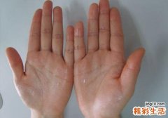 手脚出汗怎么调理