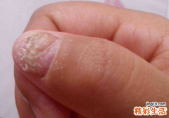 指甲有凹陷是怎么回事 警惕疾病因素，尽快对症治疗！