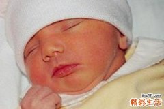 新生儿溶血症症状