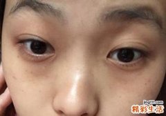 眼睛下面长斑是怎么原因