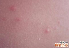 腿上长了很多小红疙瘩很痒怎么办