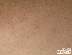 腿上长了小红疙瘩不痛不痒怎么办