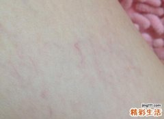 腿上有红血丝是怎么回事