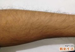 女生脸上汗毛重是什么原因