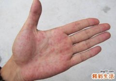 手指脱皮有红点怎么回事