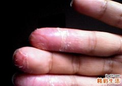 手指脱皮溃烂怎么办
