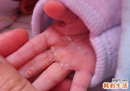 小孩手指脱皮是缺什么