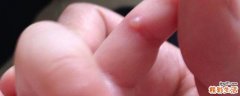 手冷冻后起的水泡怎样让它快速好 冷冻水泡弄破了会传染吗