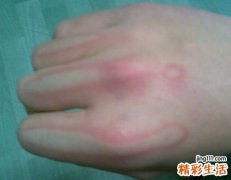 烫伤时的处理五部曲