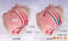 人为什么会打呼噜 打呼噜就是睡得香吗？