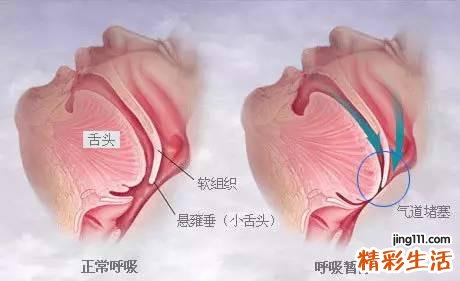 人为什么会打呼噜 打呼噜就是睡得香吗？