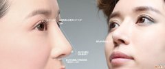 鼻当家鼻整形修复告诉你一般鼻部整形后有什么后遗症呢？该怎么处理？