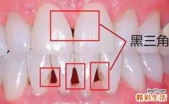 矫正后牙齿出现了黑三角，该怎么办？重庆三级口腔医院专家给你支招